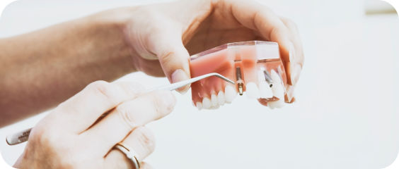 Root Canal Treatment Lewisville Tx