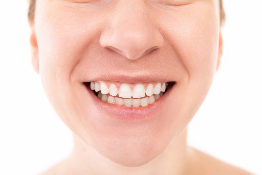 Best Teeth Whitening the colony