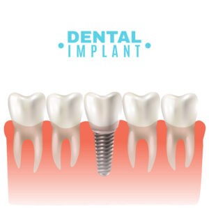 Restorative Implant Dentistry