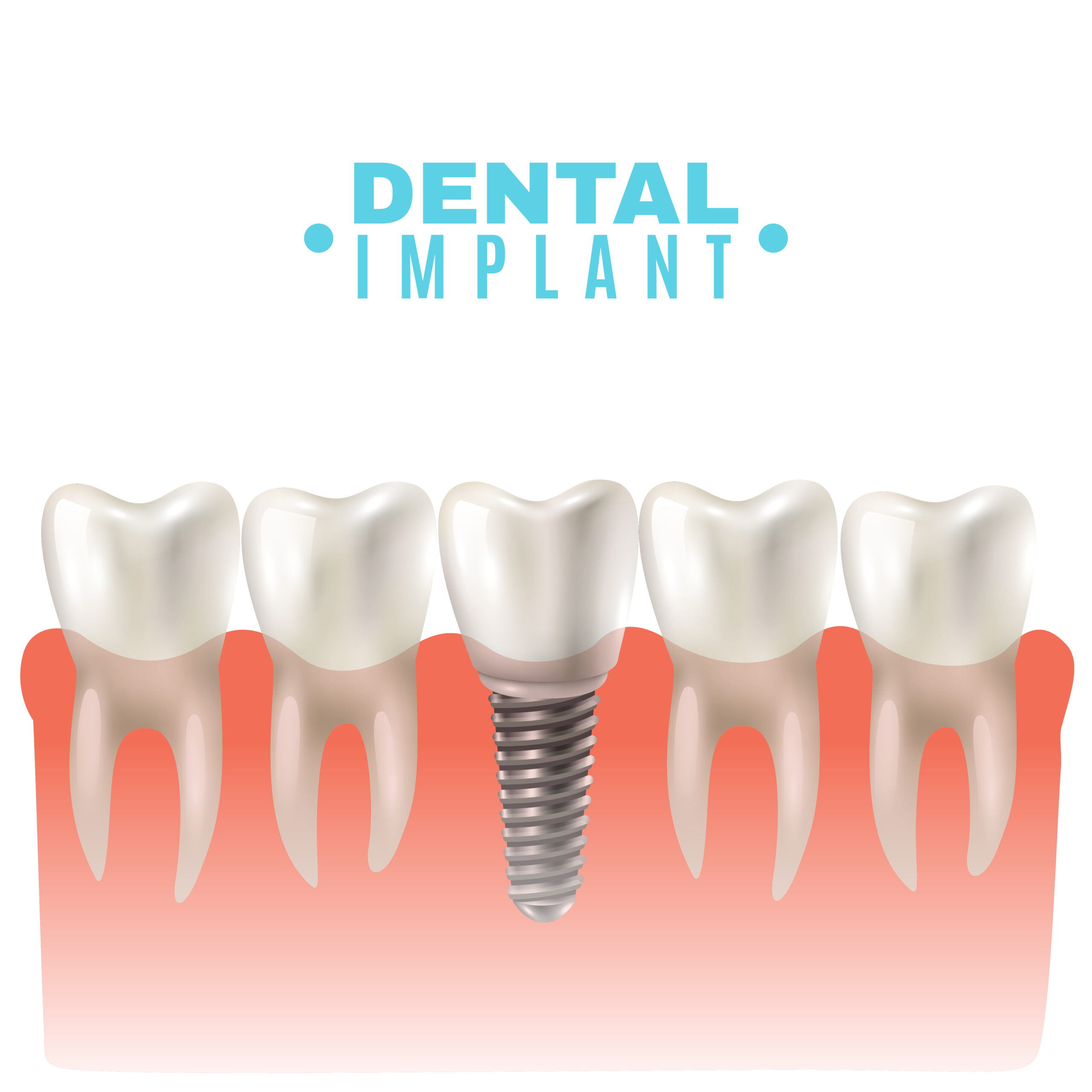 Restorative Implant Dentistry