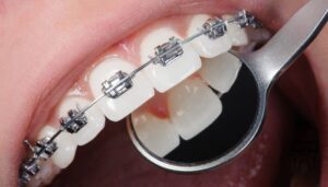 Orthodontics treatment Hillcrest Dental