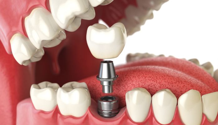 Dental Implants lewisvillle