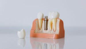 Dental Implants in Lewisville