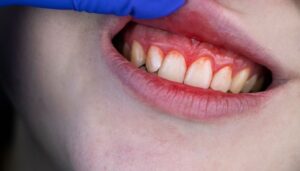 Gum Inflammation