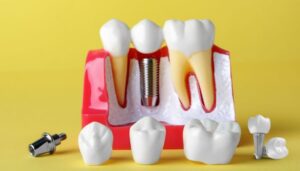 dental implant
