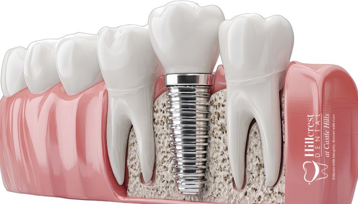 Dental implants