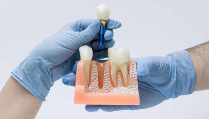 Tooth Replacement