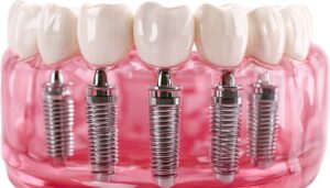 Same Day Dental Implants
