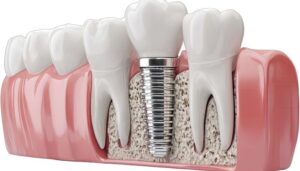 Dental Implant Repair: Restore Your Smile & Health
