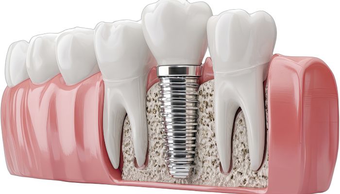 Dental Implant Repair: Restore Your Smile & Health
