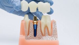 Dental Crowns Lewisville TX: Types, Benefits, and What to Expect